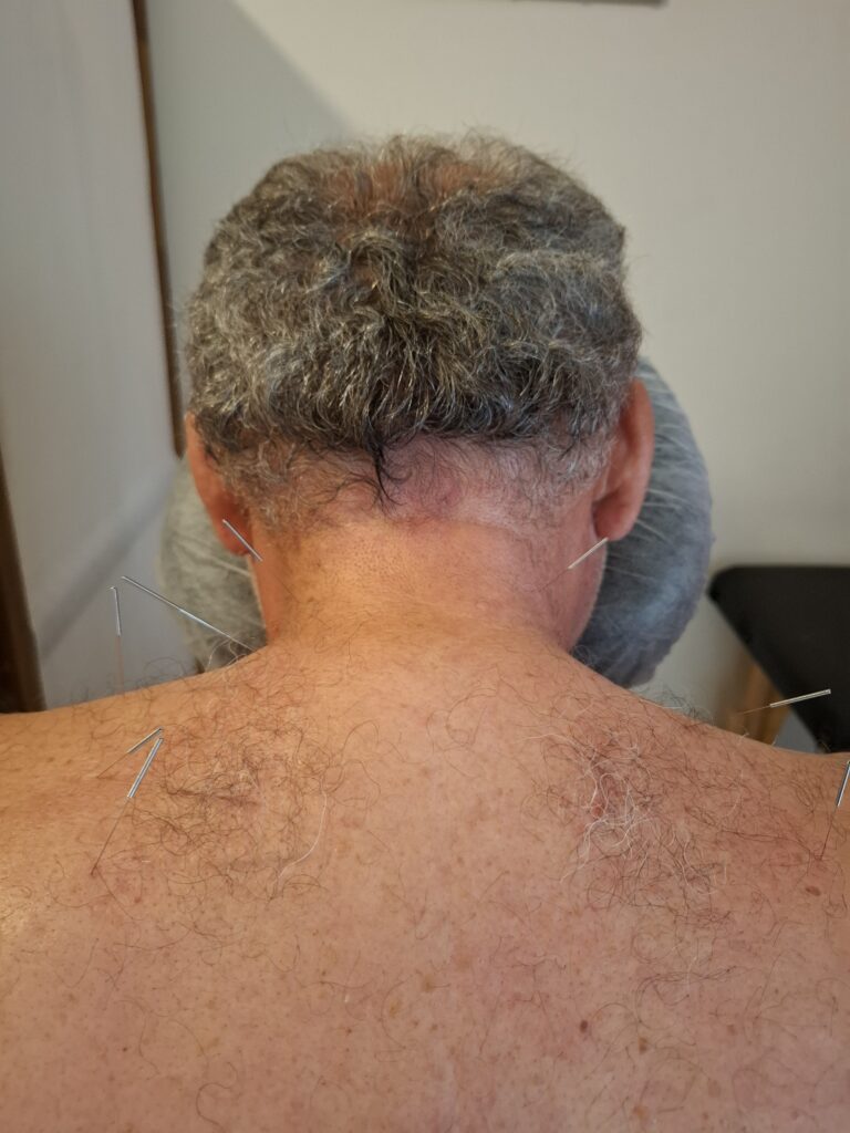 Μια σύγχρονη φυσικοθεραπευτική τεχνική για τη μείωση του πόνου, τη χαλάρωση των μυών και τη βελτίωση της κινητικότητας.